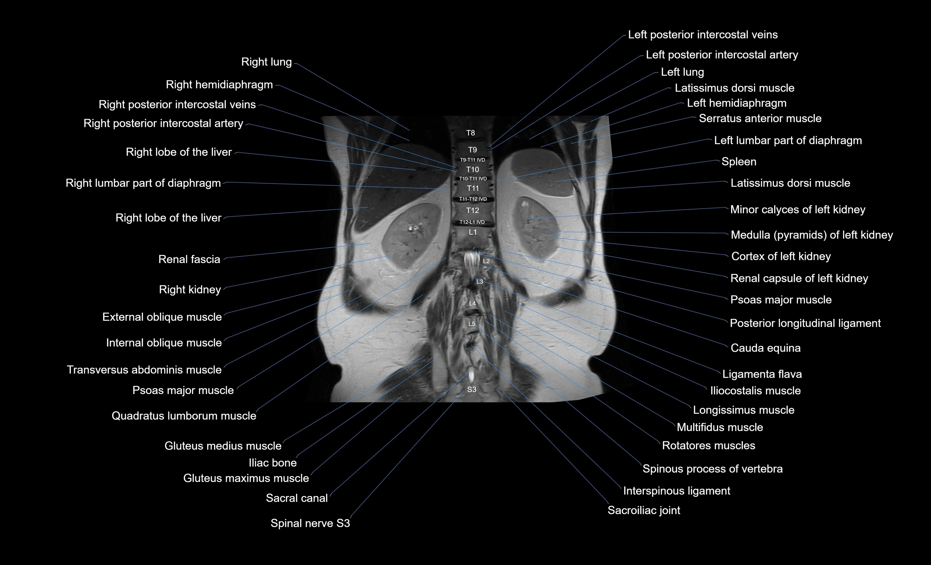 MRI Abdomen coronal labelled cross sectional anatomy radiology  image-img-00001-00045.webp